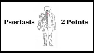 Hijama Points  Psoriasis [upl. by Sutsuj]