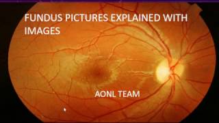 Fundus images explained by an ophthalmologist [upl. by Adekam]