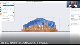 FORMATION IMPRESSION GUIDE CHIRURGICAL [upl. by Selrac]