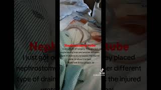 Nephrostomy tube placement kidneyrecipient kidneywarrior urineleak transplantwoes transplant [upl. by Lashoh]