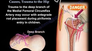 AVN Femoral Head Causes Trauma To The Hip  Everything You Need To Know  Dr Nabil Ebraheim [upl. by Nairahcaz884]