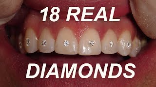 18 REAL DIAMONDS PUT IN TEETH TIME LAPSE [upl. by Notsirk]