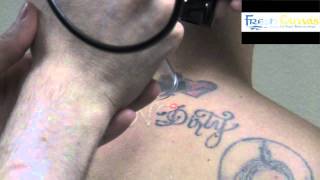 Larrys Laser Tattoo Removal Journey with Dr HL Greenberg at Las Vegas Dematology® [upl. by Ordway]