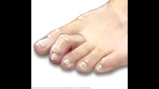 How to treat hammer toes without surgery  Benjamin Marble DPM [upl. by Nixie]