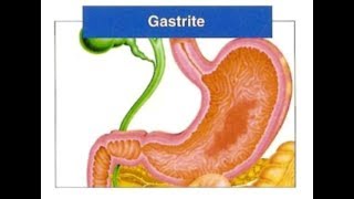 Gastrite crônica  Como se curar dela [upl. by Onairelav]