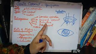 SENILE CATARACT very IMPORTANT topic ade simple part 1 [upl. by Allesiram507]