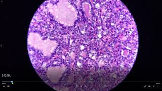 Encapsulated Follicular Variant of Papillary Thyroid Carcinoma EFVPTC [upl. by Vez]