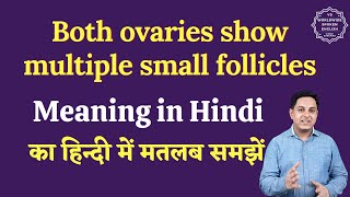 Both ovaries show multiple small follicles meaning in Hindi  English to hindi [upl. by Tedra468]