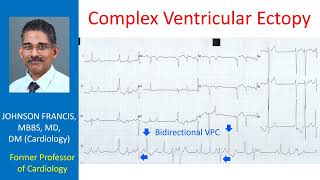 Complex Ventricular Ectopy [upl. by Shirline703]