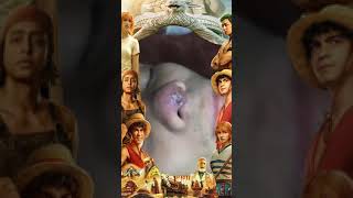 Blackheads Removal  Acne Treatment and Very Satisfying Satisfying Pimple pop blackheads [upl. by Bravar]