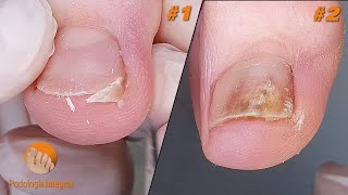 2 cases 1 video VI  1 Difficult to access nails  2 Nail trimming and cleaning of onychomycosis [upl. by Sirah]