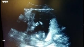 Watch a Baby Clapping in Rhythm During Ultrasound [upl. by Relyhs]