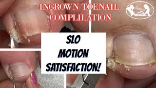 👣Satisfying Ingrown Toenail Compilation with Slo Motion 👣 [upl. by Ecikram]