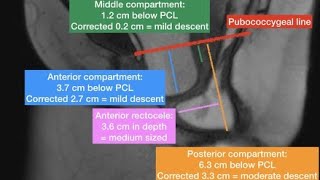 MRI Defecogram Proctogram [upl. by Akit670]