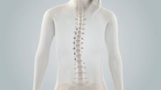 Spinal Tethering Surgery [upl. by Nuahc]