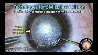 CataractCoach 1426 techniques for SMILE laser vision surgery [upl. by Kire]