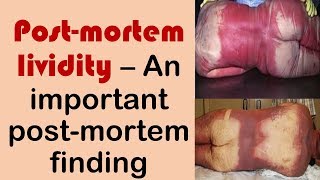 Postmortem lividity  An important postmortem change [upl. by Llerrehc]