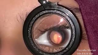 Fundoscopy using 20D lens Demonstration  Optometry  TUF [upl. by Kosiur]