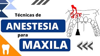 Entenda as TÉCNICAS ANESTÉSICAS PARA MAXILA [upl. by Lika]