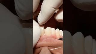 Class IV composite restoration dentist satisfying [upl. by Enait]