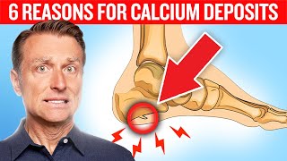 6 Reasons for Calcium Deposits Spurs Osteophytes Stones and Tartar [upl. by Adnarym974]