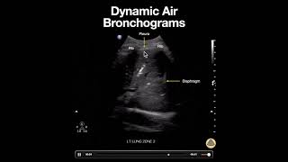 Dynamic Air Bronchograms in Lobar Pneumonia [upl. by Yrac]