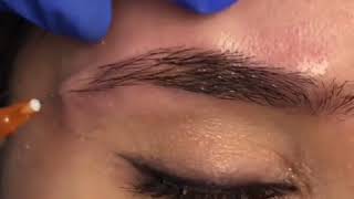 Removing Eye Bags Without Surgery  Radium Medical Aesthetics [upl. by Nottus]