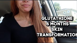 6 Months Of Glutathione  Whats Happening To My Skin [upl. by Griggs]