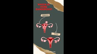 Which is more dangerous fibroid or cyst [upl. by Atteval]