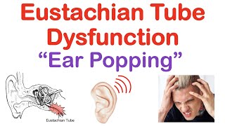 Eustachian Tube Dysfunction “Popping Sound in Ears”  Causes Symptoms Diagnosis Treatment [upl. by Ahseat]