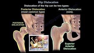 Dislocation of the hip  Everything You Need To Know  Dr Nabil Ebraheim [upl. by Auka]