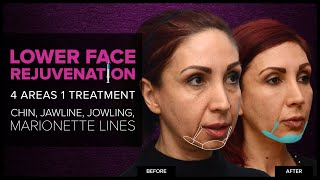 Lower Face Rejuvenation Chin Jawline amp Jowls With Dermal Fillers at Mabrie Facial Institute [upl. by Aeiram]