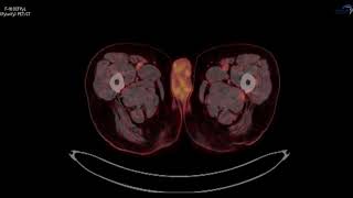 PSMA PETCT F18 Pylarify Case 6 [upl. by Kcub]