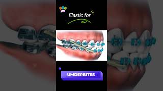 Underbite braces transformation bracesorthodontist dentist shortsfeed [upl. by Aziaf]