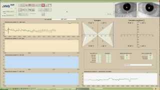 eVNG Caloric Test Demo [upl. by Sirotek]