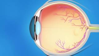 Glaucoma Implant Surgery [upl. by Croydon]