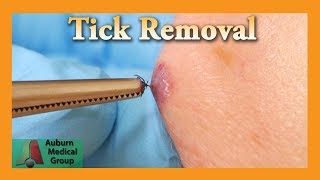 Dead Tick Removal  Auburn Medical Group [upl. by Aigneis397]