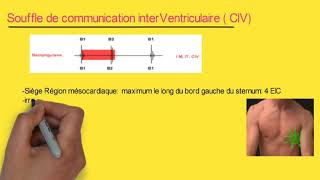 Souffle de la communication interventriculaire quotCIVquot  infos à retenir  audio [upl. by Malin]