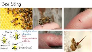 Bee sting  How to treat a bee sting [upl. by Bonni]