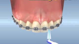 ortodontik tedavi sırasında ara yüz fırçası kullanımı [upl. by Annahael946]
