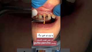 ما هو اسم مادة حشو العصبgutta percha ازاي بنحشي عصب الأسنان drabdullahsultandentist dentist [upl. by Leyla507]