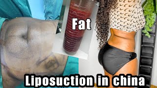 MY LIPOSUCTION EXPERIENCE IN CHINA  no cap blacksinchina liposuction liposuctioninchina [upl. by Ahsikan739]