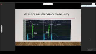 AVNRT Ablation Dr Ahmed Abdelmoniem [upl. by Enyledam]