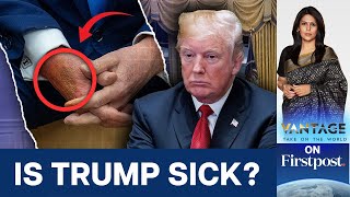 Mysterious Bruise Appears on Trumps ​Hand Where Did it Come From  Vantage with Palki Sharma [upl. by Eniarol]