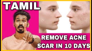 REMOVE ACNE SCAR IN 10 DAYS  TAMIL  HOUSE OF MAVERICK [upl. by Tnerb]