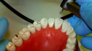 Occlusal Equilibration [upl. by Andaira168]