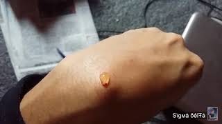 How to remove Ganglion Cyst without surgery on your own [upl. by Anile933]