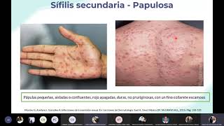 Sífilis  Dermatología [upl. by Nylatsirhc]