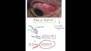 Scleritis  Case Discussion In A Minute Mustknow Shorts [upl. by Einatirb127]