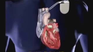 Implantable Cardioverter Defibrillator ICD [upl. by Yhtomit]